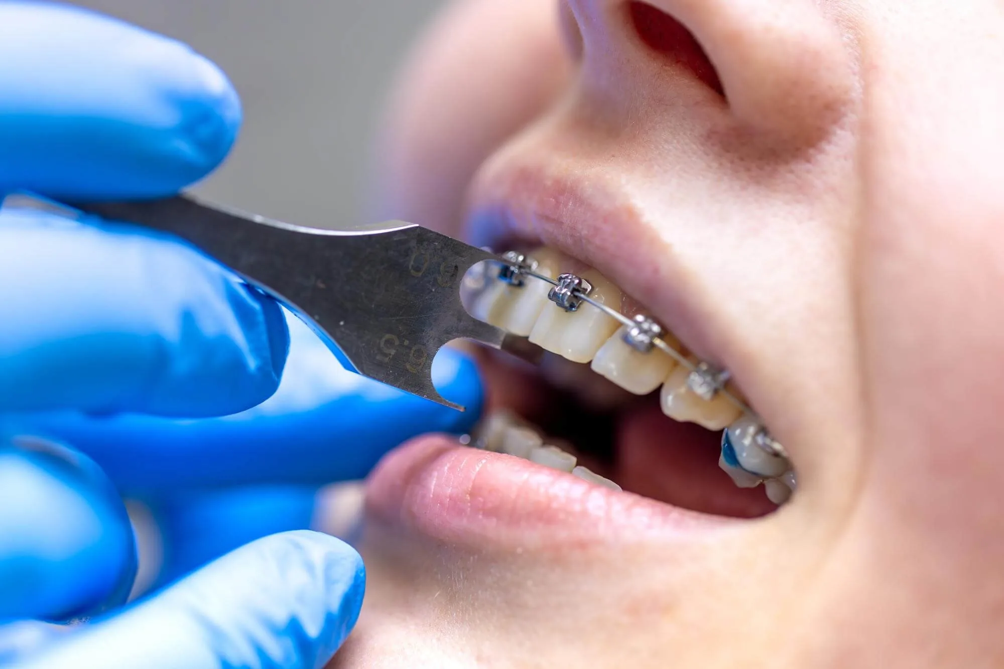Close-up of a person's mouth with braces on their teeth, being cleaned by a dental professional using a dental tool. The person is smiling slightly, and the professional's hands are wearing blue gloves.